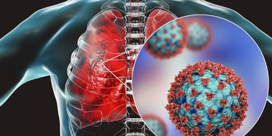 Coronavirus-disease-of-the-lungs-conceptual-illustration_G_1220618818-1720x1146